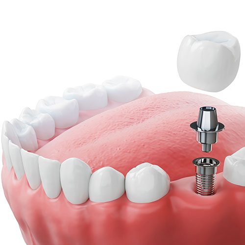 impianto dente singolo